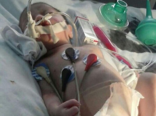 Muere bebé que se quemó tras caerle lámpara en hospital