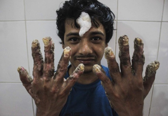 La vida le sonríe al 'hombre árbol' de Bangladesh