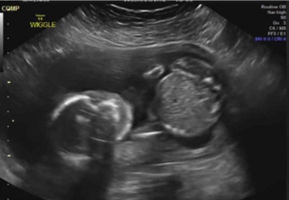 Ultrasonido muestra a un bebé dándose un puño en la cara
