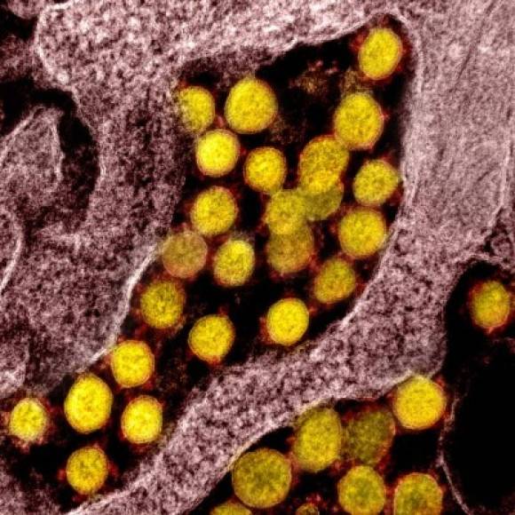 Imágenes de partículas dle coronavirus sobre una célula humana, tomadas con un microscopio electrónico y coloreadas en forma artificial.