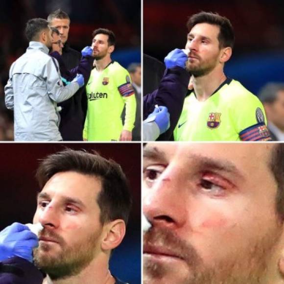 Messi es atendido por los médicos después del duro golpe y así le quedó el ojo izquierdo.