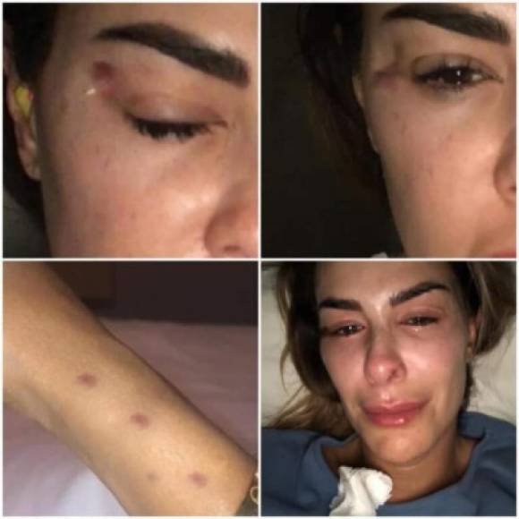 En las imágenes Ninel Conde luce con marcas en el rostro, específicamente en el ojo derecho, y raspones en uno de sus brazos.<br/><br/>