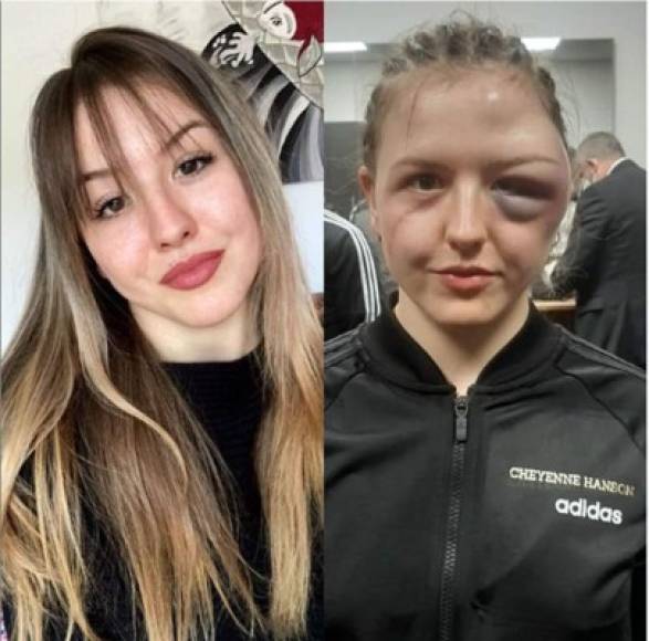 Cheyenne Hanson publicó el antes y después de su pelea, de cómo le quedó la cara desformada luego del choque de cabezas con Aline Zaitseva.