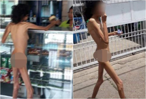 Venezolana con desnutrición severa sale a las calles desnuda a mendigar comida
