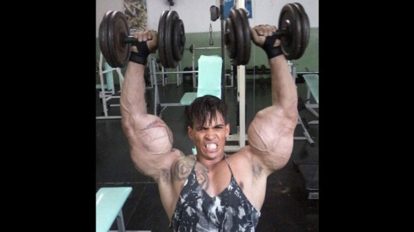 El brasileño que quería parecerse a Hulk y casi pierde sus brazos en el intento