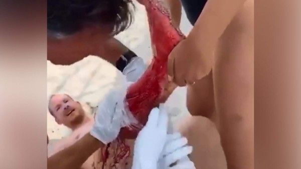 VIDEO: Hombre fue atacado por un tiburón mientras disfrutaba de la playa en Miami