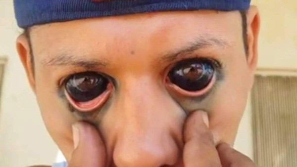 ¡Insólito! Hondureño se tatúa los ojos