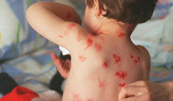 Aumentan los casos de varicela por altas temperaturas en Honduras