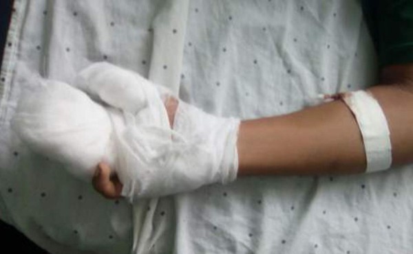 Joven pierde tres dedos de la mano por quema de pólvora en Gracias