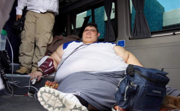 El hombre más obeso del mundo será operado en México tras perder 175 kilos