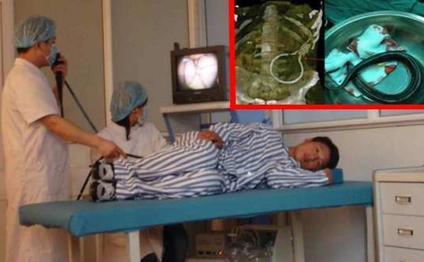Hombre introduce anguila en su recto y termina en el hospital