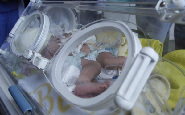 De un infarto mueren siamesas en hospital de San Pedro Sula