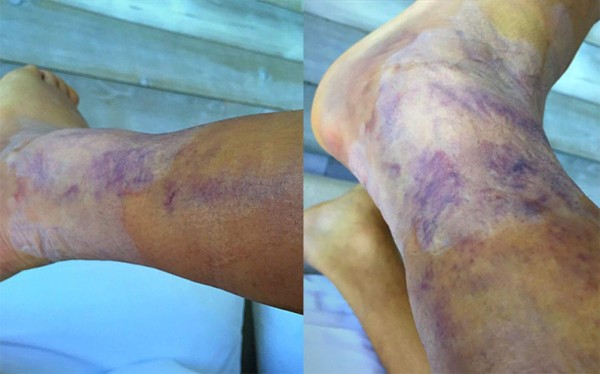 La impactante imagen del tobillo izquierdo de Alexis Sánchez