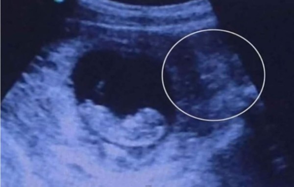 Ultrasonido enciende la polémica al mostrar a un 'demonio' vigilando feto