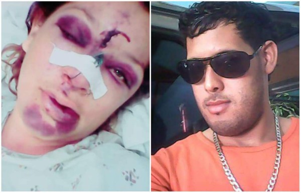 Hondureña ingresa al hospital tras recibir salvaje paliza de su pareja