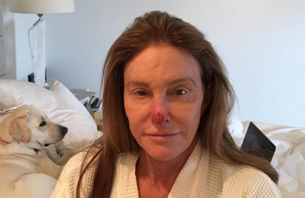 Caitlyn Jenner mostró su nariz tras operarse por cáncer