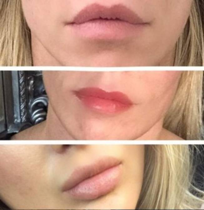 Uno de los tratamientos que más promueve es la micropigmentación en los labios.