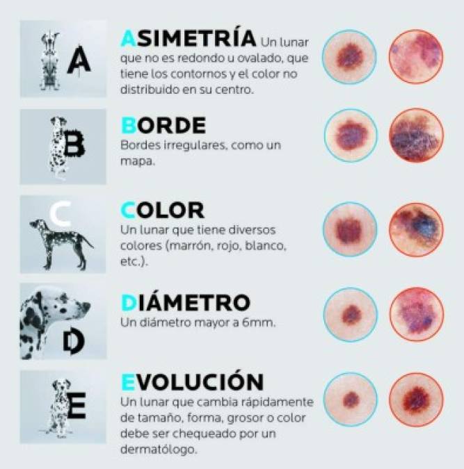 Conoce la regla del ABCDE<br/><br/>Realiza regularmente mínimo 3 veces por año un auto examen de tu piel para reconocer los signos sospechosos en cuanto aparezcan. Es fácil realizarla, solo ayúdate con un espejo, o alguien de tu confianza, siguiendo la “regla del ABCDE”, la que nos de la diferencia entre un lunar y un melanoma.<br/><br/><br/>La presencia de uno o más de estos criterios no significa que tengas un melanoma, pero tampoco debe ser ignorada: a la más mínima duda, consulta a tu dermatólogo.<br/><br/>