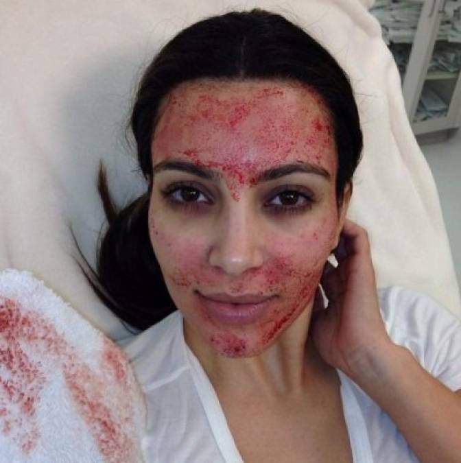 La mascarilla 'Facial Vampiro' que se aplica Kim Kardashian consiste en extraer sangre del cuerpo con una aguja para volver a inyectarla en diferentes puntos de la cara. El fin es mantener un aspecto sonrosado y joven a través de la reincorporación de plaquetas.