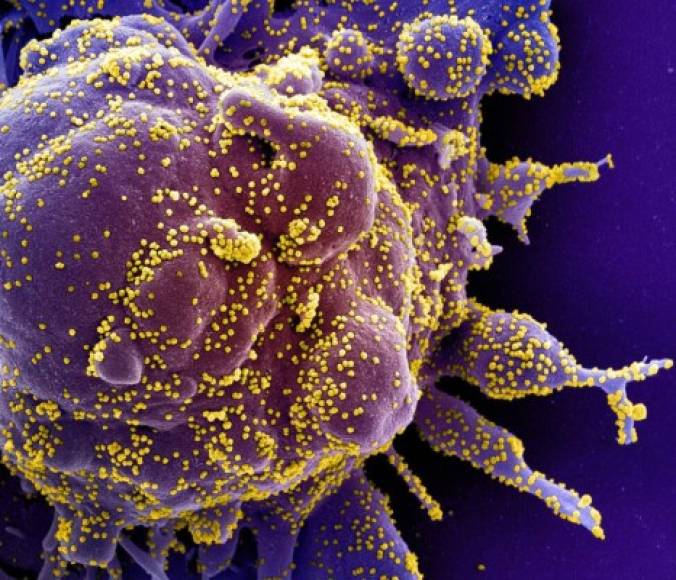 El Instituto Nacional de Alergias y Enfermedades Infecciosas de Estados Unidos ha compartido numerosas fotografías del SARS-CoV2, conocido como coronavirus o COVID-19, infectando células humanas. Así se ve.