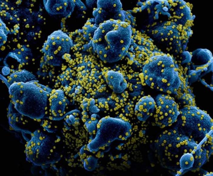 Las células de las imágenes están sufriendo apoptosis (la muerte de la célula); los cientos de puntos sobre cada una de estas células (de diferente tipo, de ahí su forma distinta) son minúsculas partículas del virus, con un tamaño de entre 120 y 160 nanómetros de diámetro.