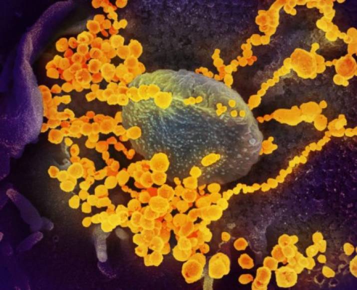 Se trata de micrografías coloreadas en las que se ven las partículas del virus, tomadas en la sede de investigaciones del Instituto Nacional de Alergias y Enfermedades Infecciosas de Estados Unidos (NIAID) en Fort Detrick, Maryland a partir de muestras de pacientes infectados.