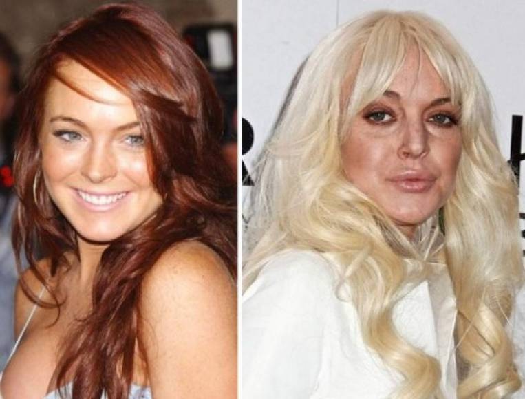Lindsay Lohan: Quien fuera la niña modelo y estrella de Mean Girls abusó de las sustancias tóxicas; en su apariencia quedó el rastro de la cocaína y el alcoholismo. Luego de someterse a varios intentos de rehabilitación, adquirió una nueva adicción: las cirugías plásticas.<br/>