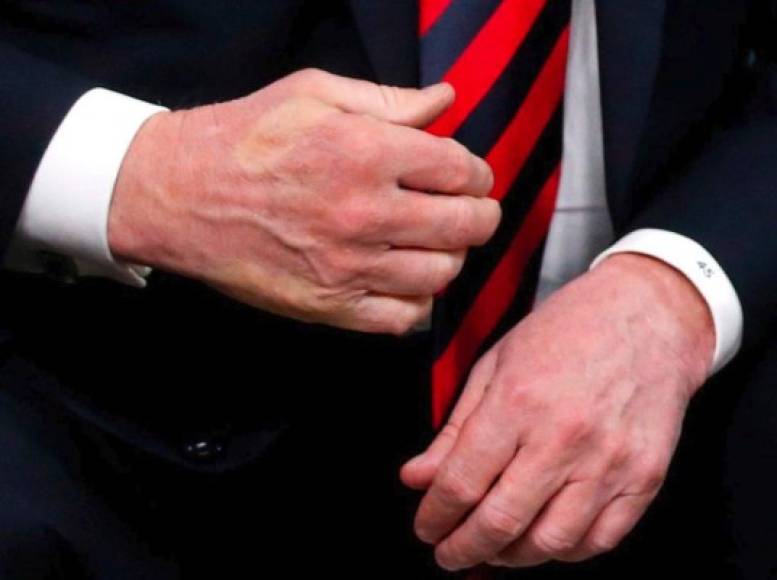 En la imagen se puede apreciar como, debido a la fuerza del saludo, el pulgar y el meñique de Macron se habían quedado grabados temporalmente en el dorso de la mano de Trump.<br/>