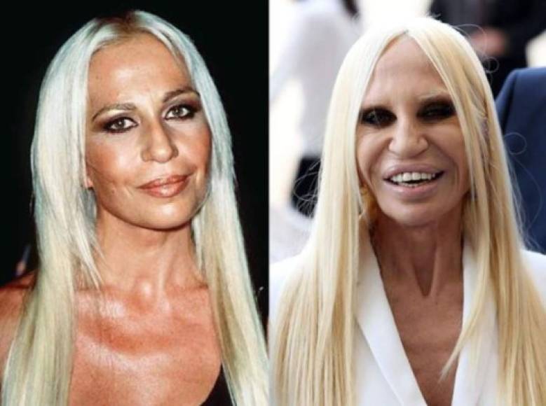 La diseñadora de 62 años Donatella Versace desformó por completo su cara. Es una de las transformaciones más asombrosas en el espectáculo.