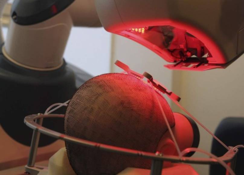 POLONIA. Robot que transplanta pelo. Sistema robótico ARTAS para transplante de pelo en Katowice para ayudar a personas con pérdidas de pelo. Foto: EFE/Andrzej Grygiel
