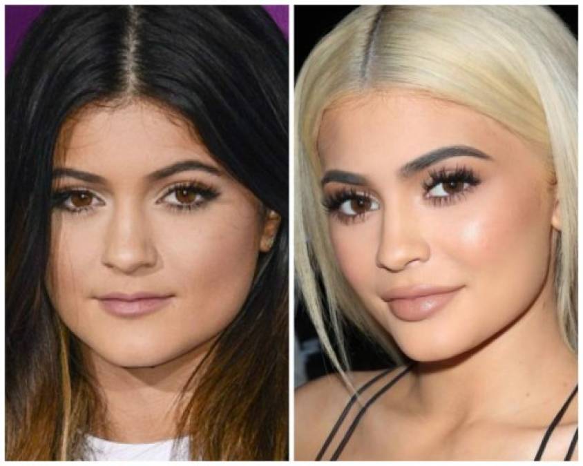 El antes y después de Kylie Jenner.