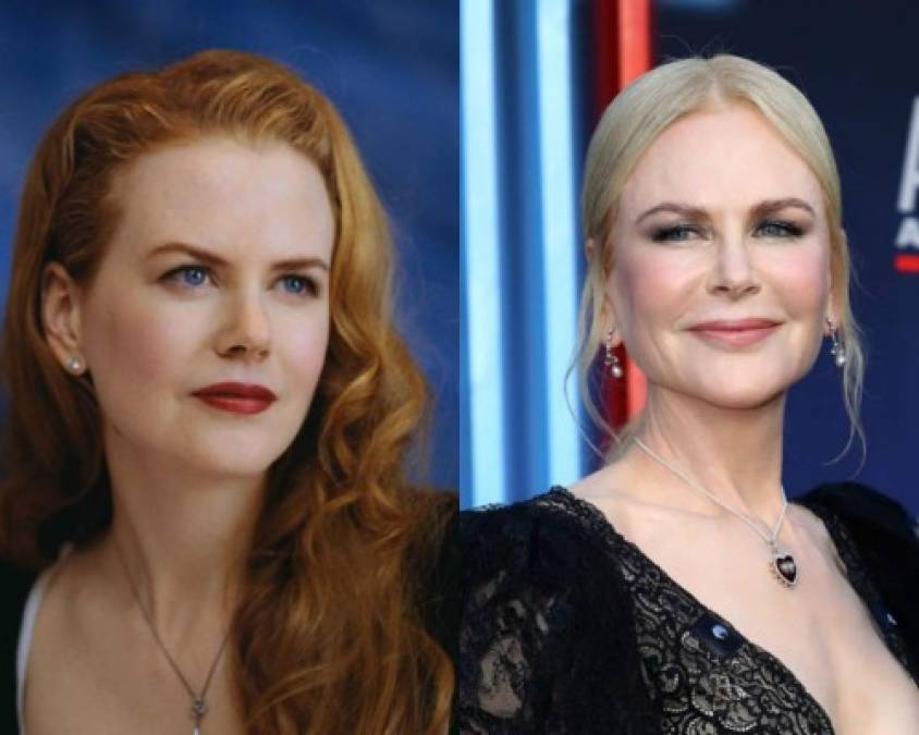 Kidman, de 52 años, en el pasado ya había estado en el ojo del huracán por su excesivo uso de bótox (que ella misma reconoció en algún momento), todo parece indicar que ha vuelto a recurrir a ese tratamiento.<br/><br/>'Me parece que después de descansar un tiempo se realizó también inyección de bótox más rellenos de ácido hialurónico, lo que le da un rostro un poco expresivo y artificial. Aunque ella ya había dicho que no volvería a aplicarse bótox, me parece que ha vuelto a las andadas y se aplicó una serie de tratamientos con vitaminas y ácidos para perfilar más su rostro', considera el especialista citado por Agencia Reforma.<br/>