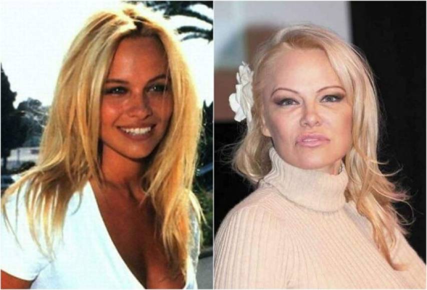 La cirugía plástica no ha sido amiga de Pamela Anderson, de ser considerada una bomba sexy, ahora la actriz de 52 años luce un rostro irreconocible.