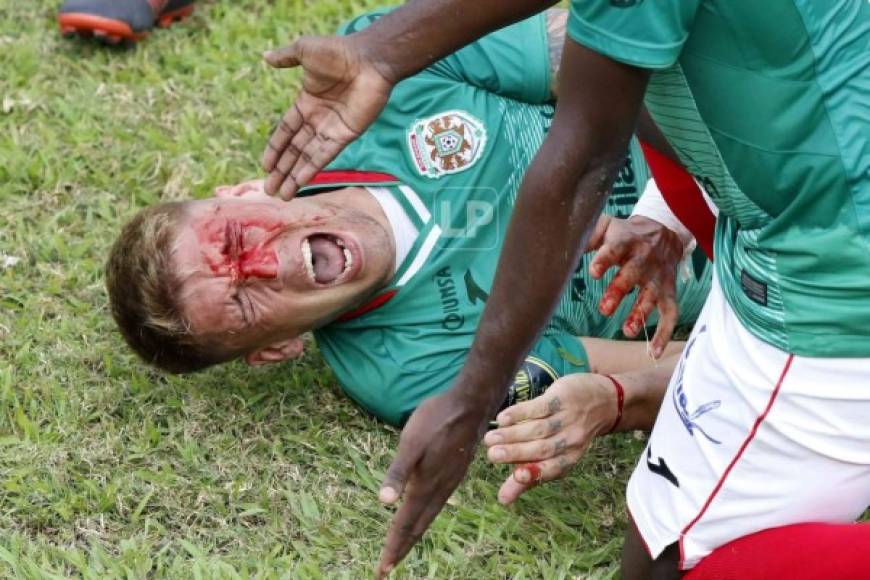 Mathías Techera sufrió un codazo de Rafael Agámez, quien fue expulsado. El defensa del Marathón sufrió una fuerte herida en el rostro.