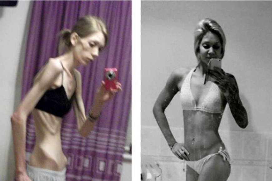 Hoy contamos la historia de Nicola King, una joven de 24 años que sufrió anorexia llegando a pesar tan solo 25 kg y ahora se ha proclamado campeona de culturismo femenino. ¡No te pierdas su increíble historia!