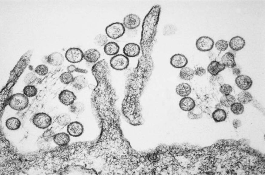 Hantavirus - Este virus al igual que los dos anteriores se contrae por zoonosis, es decir que los animales pueden contagiar a los humanos, en este caso son los roedores, a través de excrementos y orina.