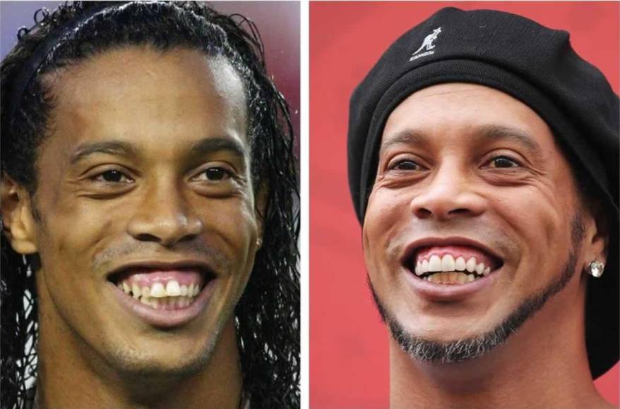 Ronaldinho - El brasileño es uno de los futbolistas que más ha sonreído dentro del terreno de juego, por lo que llamó mucho la atención cuando después de su retirada decidió pasar por el dentista para lucir una nueva y mejorada sonrisa.