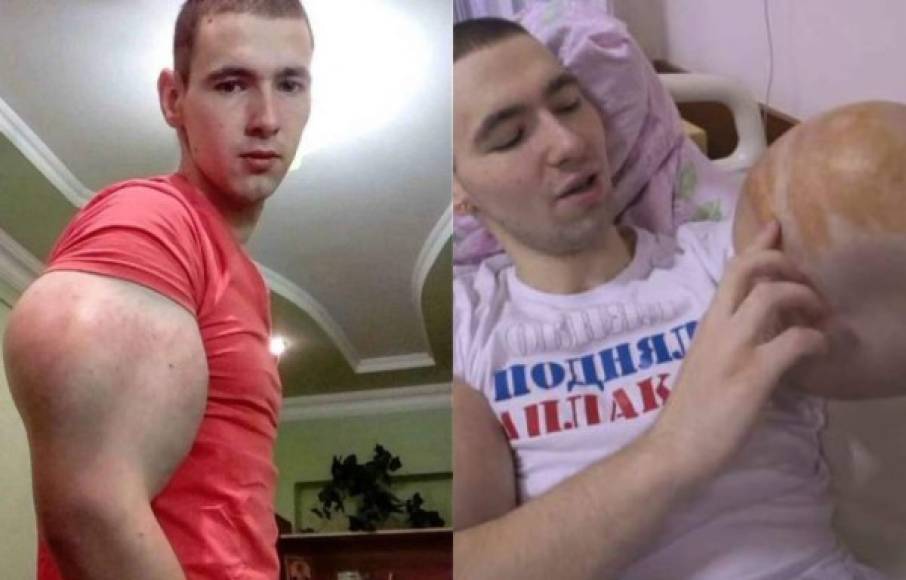 Kirill Tereshin, más conocido como el Popeye ruso, se ha sometido a una cirugía para evitar la muerte ya que no soportaba el dolor en sus brazos. En los últimos memes vivió un verdadero drama.