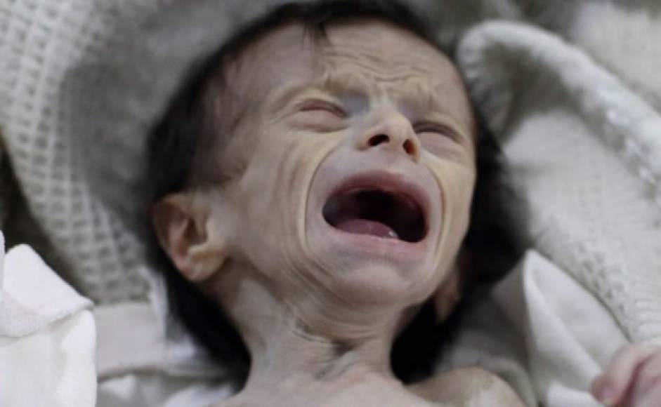 Las imágenes de Saha Dofdaa, una niña con un severo caso de desnutrición, expone los horrores que afectan a Siria, envuelto en una guerra civil desde el 2011 que ha costado más de 300,000 vidas, según estimaciones de organismos de Derechos Humanos.<br/><br/>ADVERTENCIA: imágenes sensibles, se recomienda discreción.