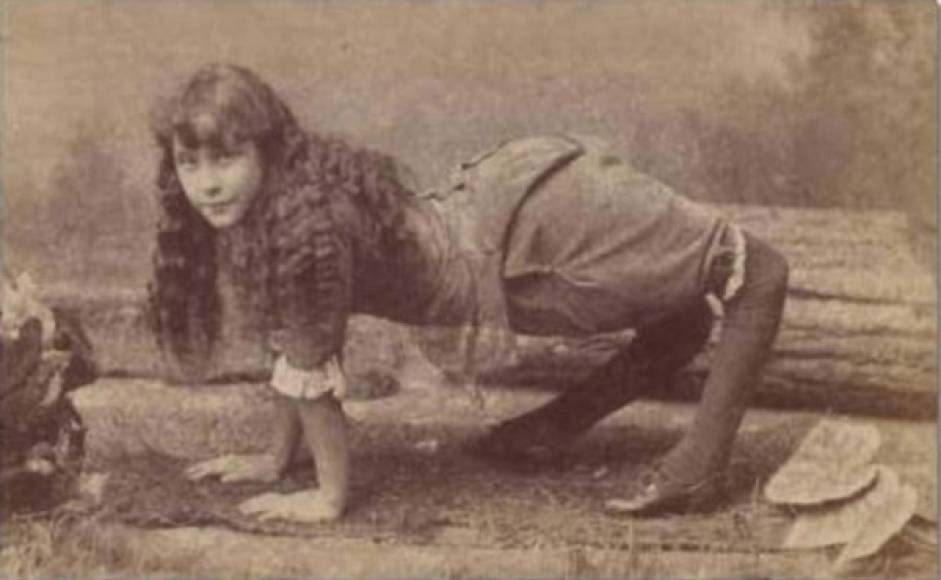 Ella Harper, también conocida como 'la niña camello', nació con una extraña condición congénita, sus rodillas se doblaban al revés y eso la obligaba caminar en cuatro patas.