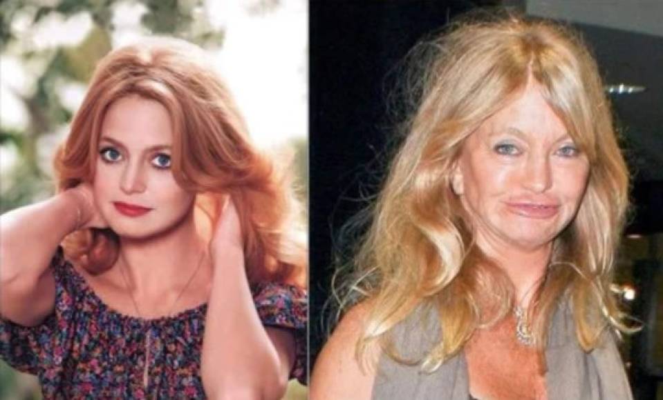 Otro de los casos de cirugías extremas muy conocido es el de la actriz Goldie Hawn, quien se sometió a innumerables procesos estéticos como el relleno de pómulos, botox y labios, con resultados bastante dudosos.<br/><br/>