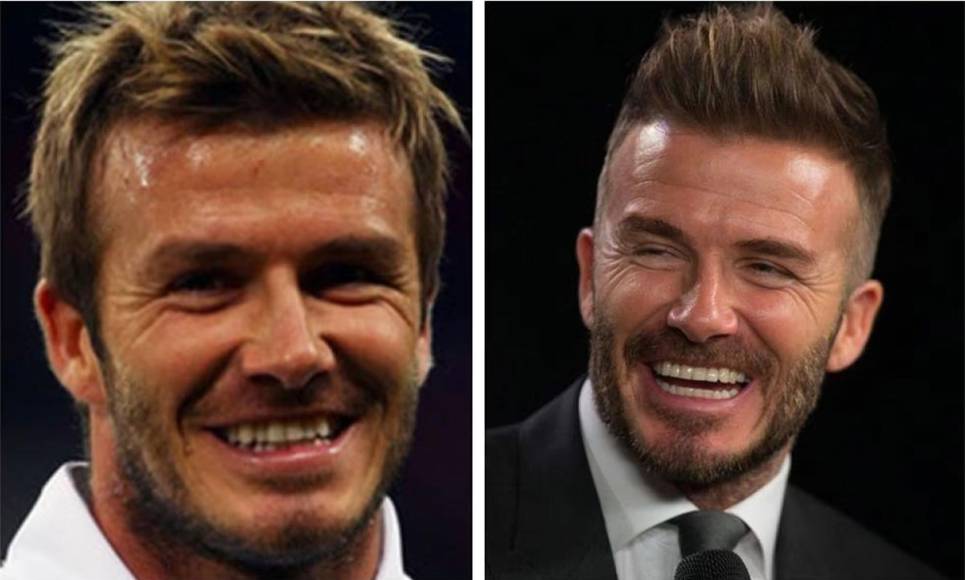 David Beckham - El inglés, exfutbolista del Real Madrid, Manchester United y PSG, entre otros, tenía un gran problema en el incisivo lateral superior, pero en la actualidad lo tiene totalmente resuelto.