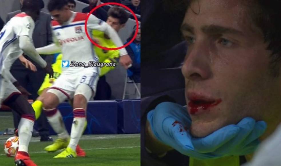 Sergi Roberto recibió un tremendo codazo por parte de Houssem Aouar y el árbitro no le mostró nada al jugador del Lyon. El volante del Barcelona terminó sangrando.