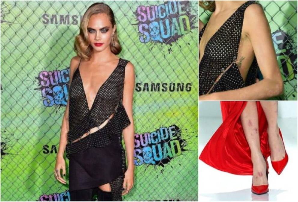 En algunas ocasiones Cara Delevingne ha hablado de la psoriasis que tiene. De hecho, a la modelo de 24 años parece que no le importa esconder este mal, ya que ha pasado por las pasarelas sin esconder sus ronchas o el enrrojecimiento de su piel.<br/><br/>El año pasado, durante el estreno de la cinta 'Suicide Squad', Cara llamó la atención por no poder maquillar las manchas, que según medios extranjeros, aumentan con sus niveles de estrés.