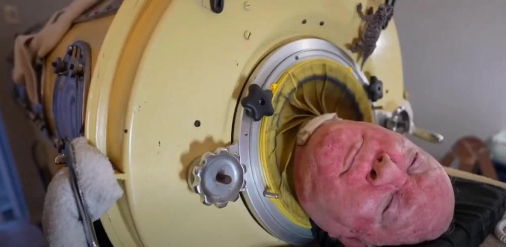 Hombre que habitaba en un “pulmón de hierro” muere a los 78 años