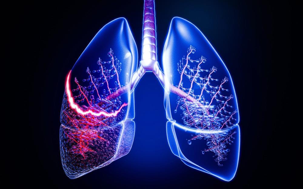Cáncer de pulmón: detectar la enfermedad a tiempo puede salvar vidas