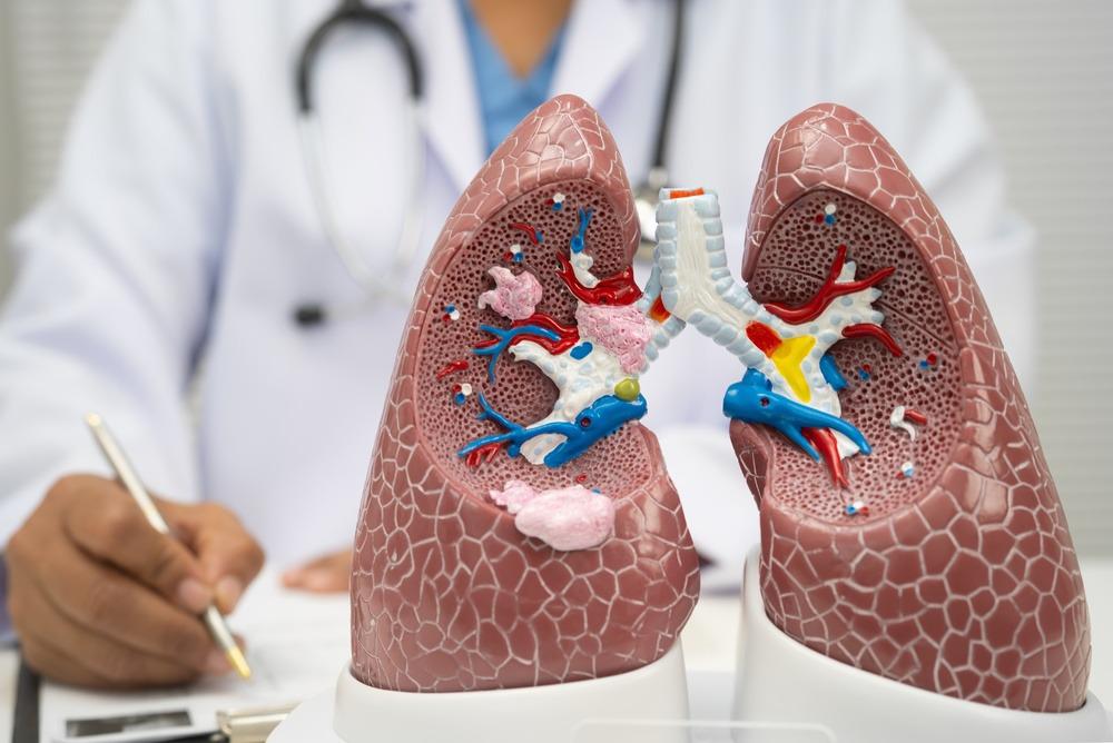 Cáncer de pulmón: detectar la enfermedad a tiempo puede salvar vidas