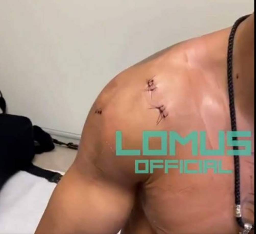 En las imágenes que publicó Lomachenko en sus redes sociales se observan cuatro incisiones y varias puntadas.