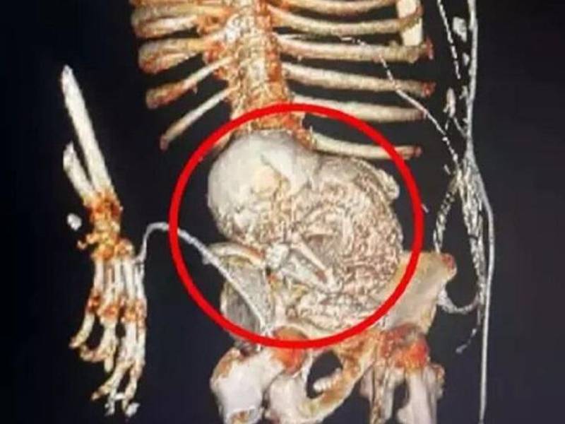 El caso del “bebé de piedra” será investigado por las autoridades del hospital.