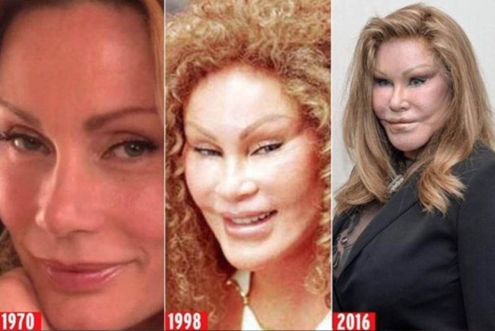 Jocelyn Wildenstein quería parecerse a un gato. Al parecer su exesposo Alec Wildenstein prefería la compañía de los felinos a la suya y por eso se convirtió en una adicta las cirugías. Lo cierto es que 'la reina de la jungla' tiene unas 30 operaciones que le han costado varios millones de dólares. Jocelyn Wildenstein sigue y seguirá haciéndose 'retoques' pues según ella misma, así es como exactamente quiere lucir. <br/><br/>